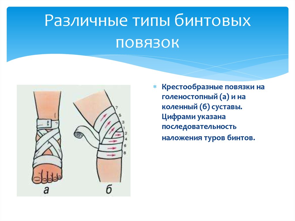 Способы перевязки ран. Различные типы бинтовых повязок. Мягкие бинтовые повязки. Правило наложение повязок. Наложение повязок на различные части тела.