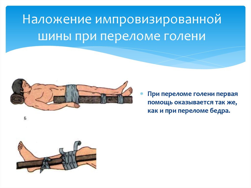 Наложение шины при переломе. При переломах костей конечностей накладывается шина:. Алгоритм шину Дитерихса накладывают при переломе костей голени. Наложение шины Крамера при переломе бедренной кости. Наложение шины Крамера при переломе костей голени.