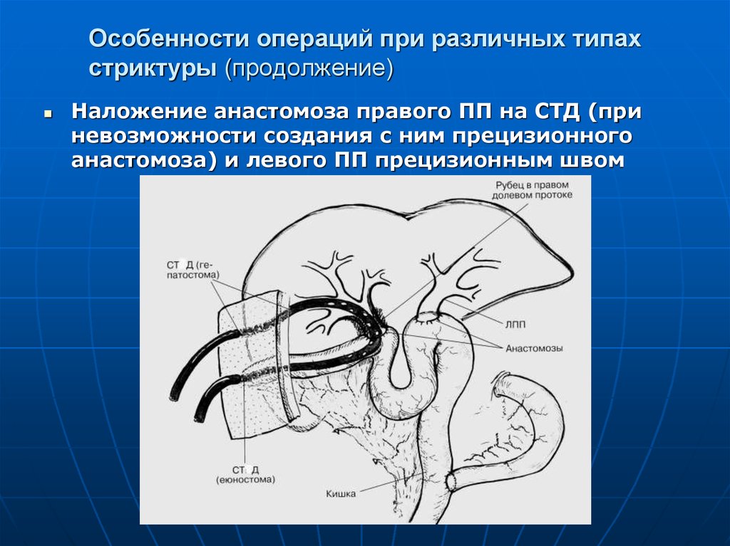 Особенности операций. Анастомоз желчных протоков. Анастомоз желчного протока. Операции при повреждении желчных протоков.