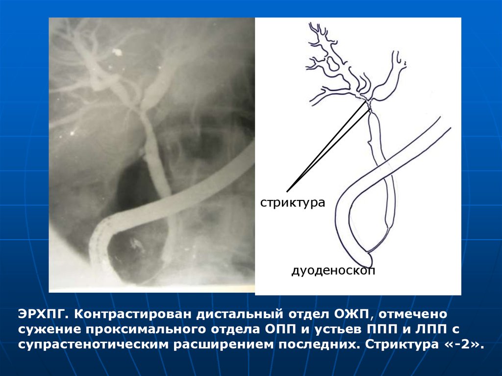 Стриктура уретры