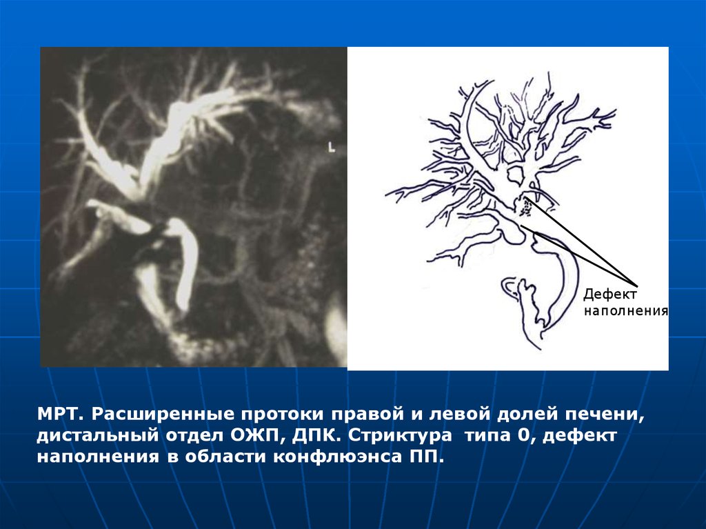 Расширения протоки. Расширение желчных протоков мрт. Расширение печеночных протоков. Расширение внутрипеченочных протоков на мрт. Мрт расширение протоков печени.