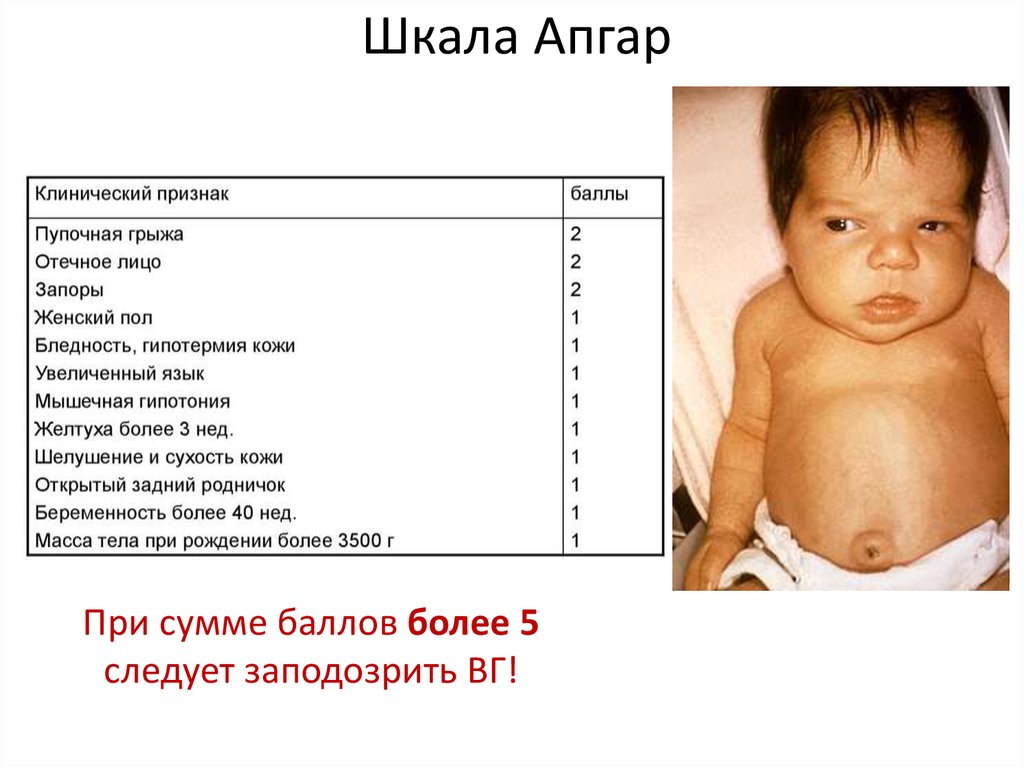 Шкала Апгар