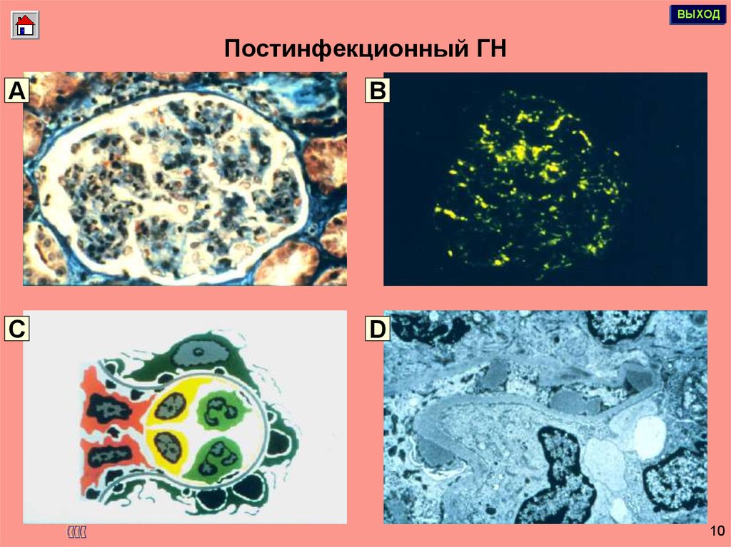 Постинфекционный гломерулонефрит. Постинфекционный.