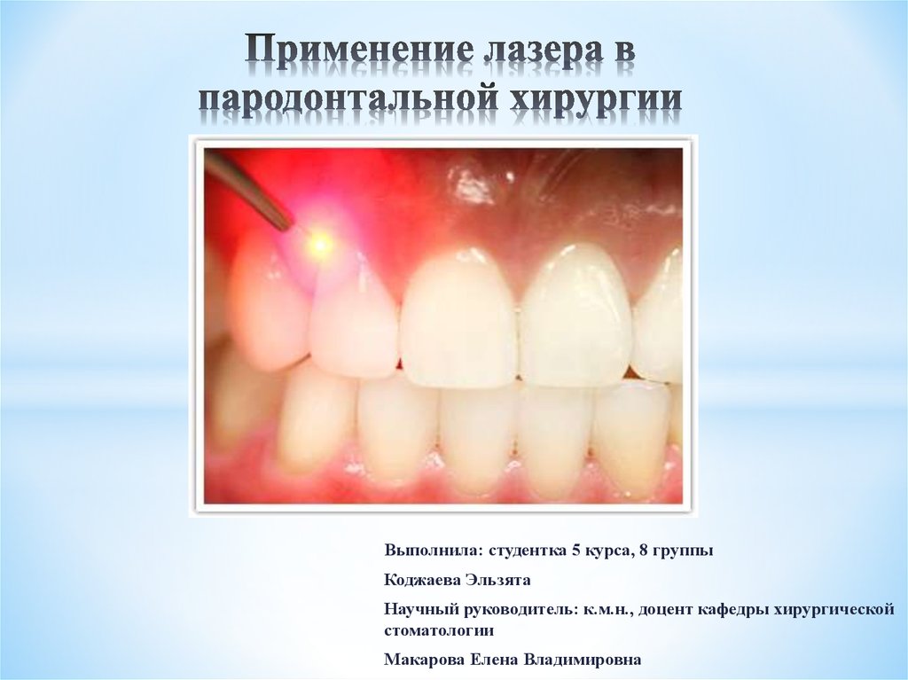Реферат: Лазеры в стоматологии