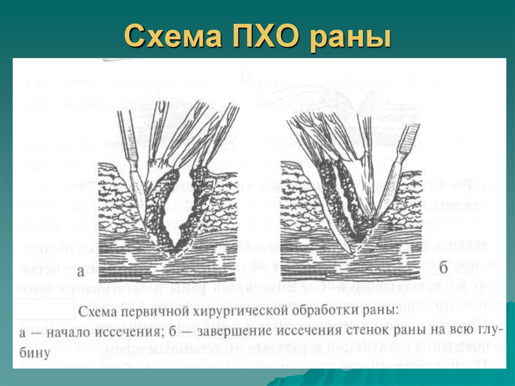 Пхо ран. Этапы обработки раны первичной хирургической обработки.