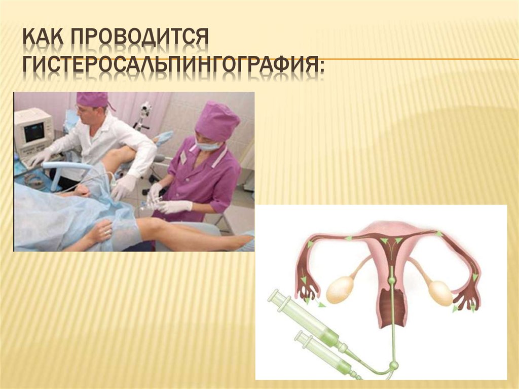 Как проводится гистеросальпингография: