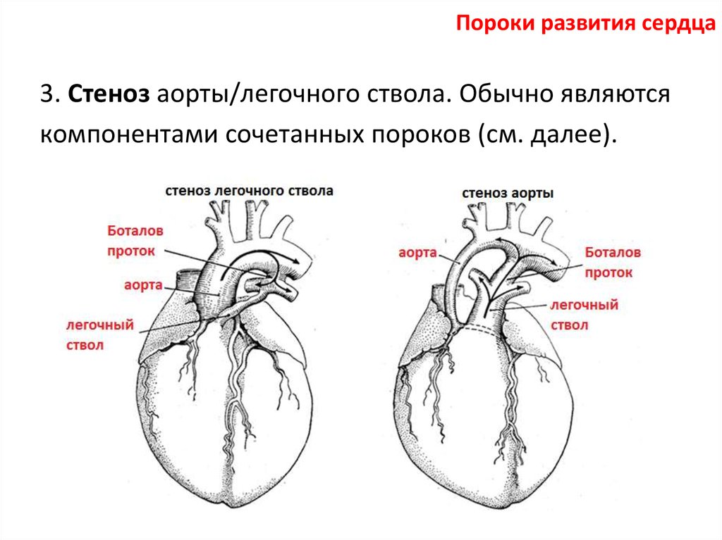 Порог сердца что это. Приобретенные пороки сердца схема. Пороки развития сердца анатомия.