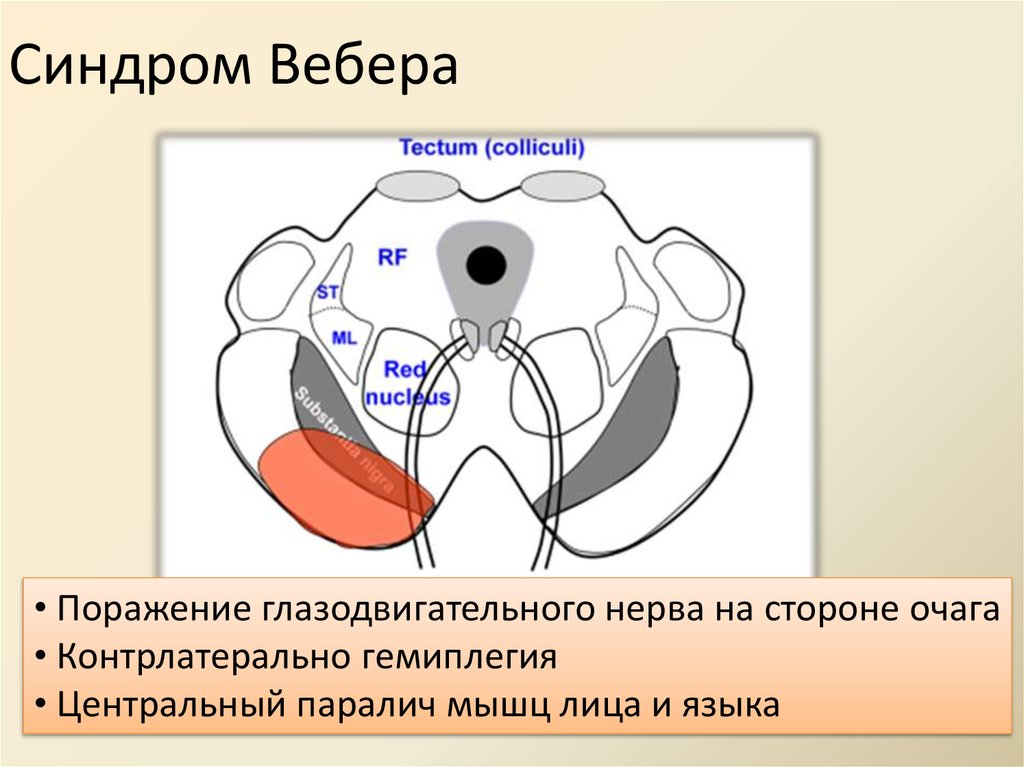 Альтернирующие синдромы схема