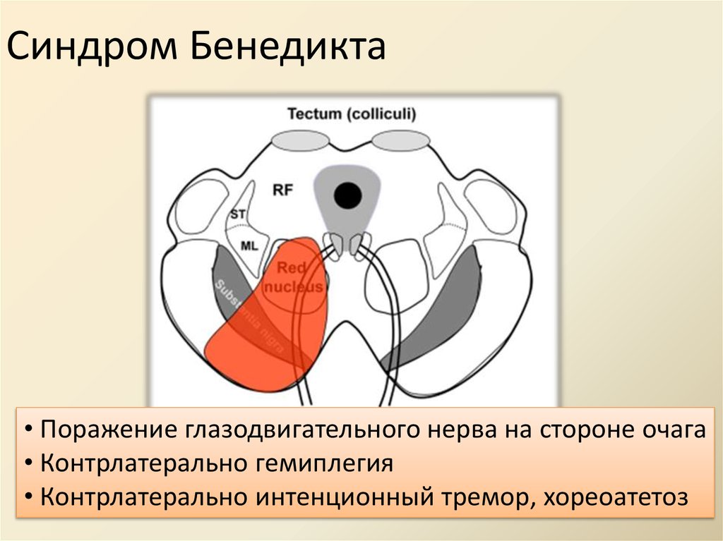 Альтернирующие синдромы схема