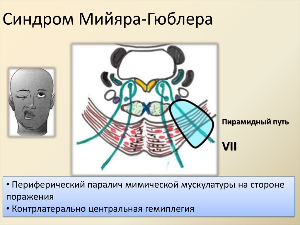 Синдром мийяра гюблера