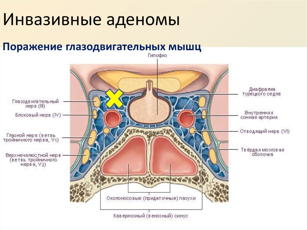 Тромбоз кавернозного. Пещеристый синус фронтальный срез. Пещеристый синус фронтальный срез топографическая анатомия. Кавернозный синус топографическая анатомия. Пещеристый синус анатомия на черепе.