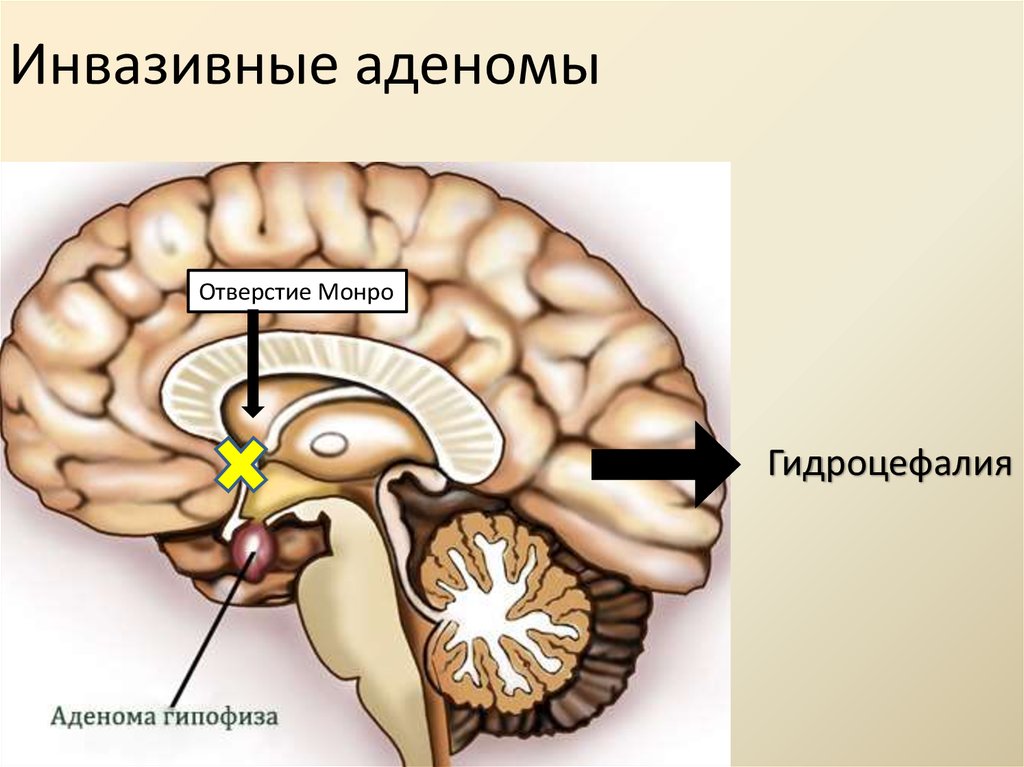 Микроаденома гипофиза головного мозга что это такое. Аденома гипофиза головного мозга. Микроаденома гипофиза головного мозга. Хромофобные аденомы гипофиза. АКТГ продуцирующая аденома гипофиза.