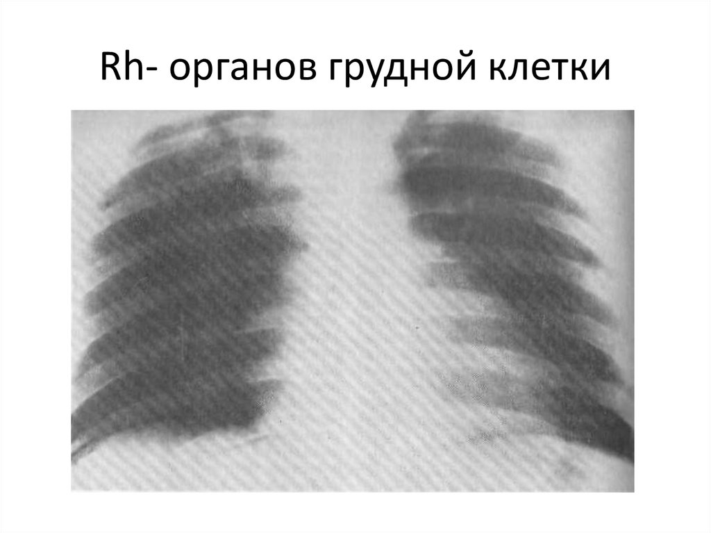 Rh- органов грудной клетки
