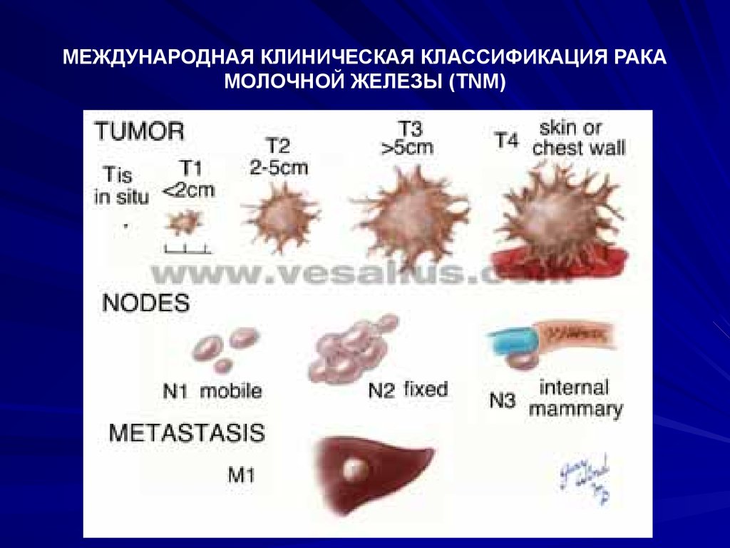 Рак молочной железы 1 стадии операция. Классификация стадий онкологии молочной железы. Классификация молочной железы гистология. Классификация TNM онкология. Классификация РМЖ по стадиям.