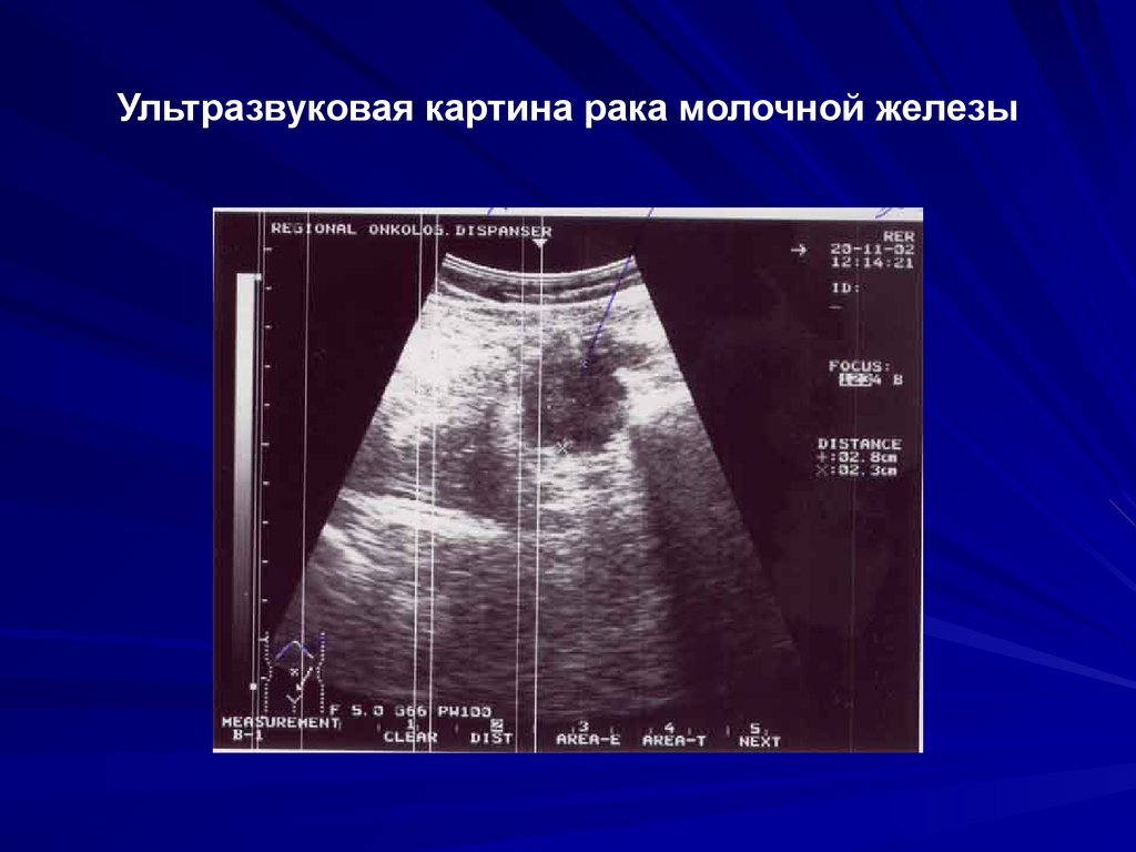 Инвазивный неспецифицированный рак. Uzi kartina raka molochnoi jelezi. Ультразвуковая анатомия молочной железы. УЗИ анатомия молочной железы. Ультразвуковая картина мастопатии.