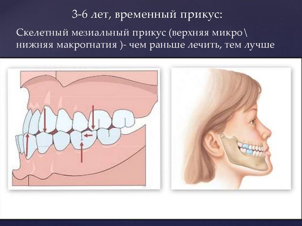 Мезиальная окклюзия презентация ортодонтия