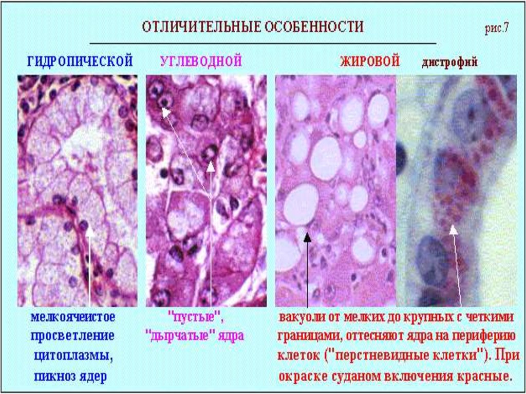 Дистрофии патология презентация