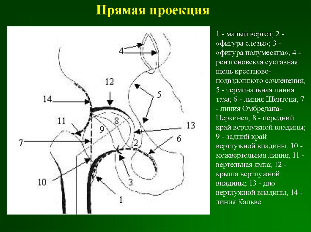 Проекция таза. Фигура полумесяца тазобедренный сустав. Фигура слезы тазобедренный сустав. Фигура полумесяца на рентгенограмме. Рентгеноанатомия костей таза.