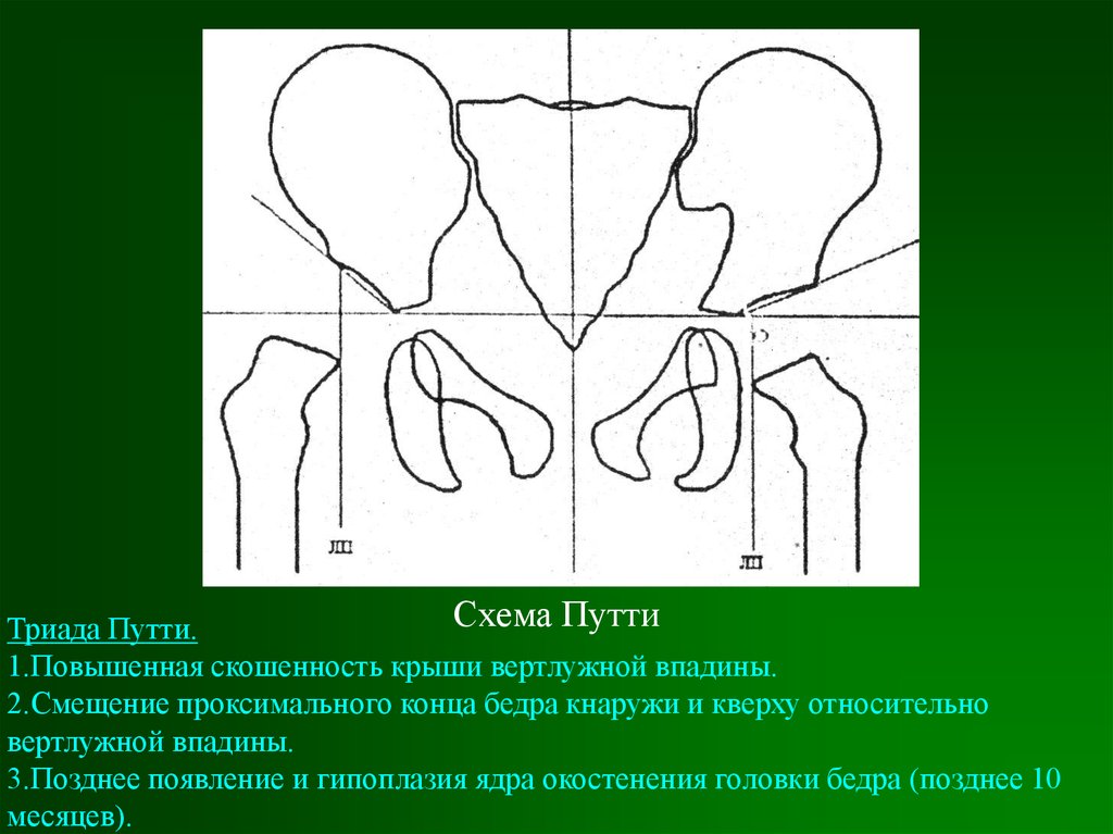 Ядро головки бедренной кости. Врожденный вывих бедра схема Хильгенрейнера. Ядра окостенения головок бедренных костей. Схема Рейнберга врожденный вывих бедра. Врожденный вывих бедра Путти.