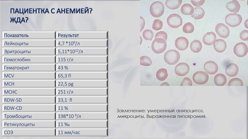 Mch анемия. Гипохромная анемия показатели крови. Анализ крови при железодефицитной анемии показатели. Показатели анализов при железодефицитной анемии. ОАК при железодефицитной анемии показатели.