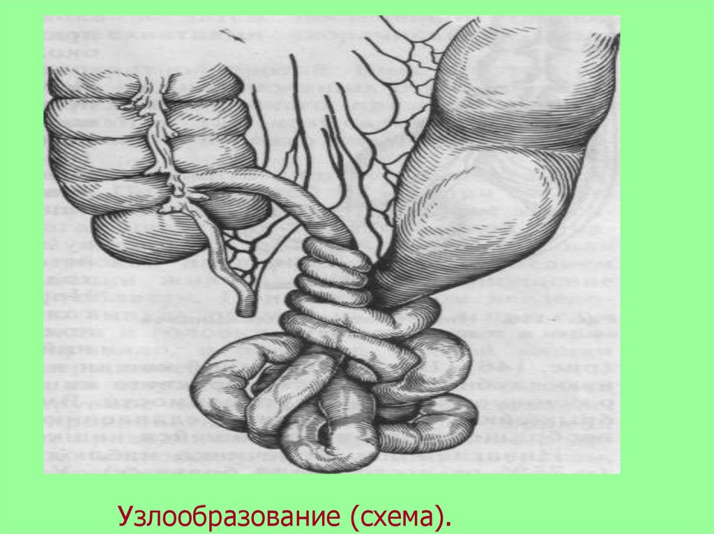 Острая кишечная непроходимость госпитальная хирургия презентация