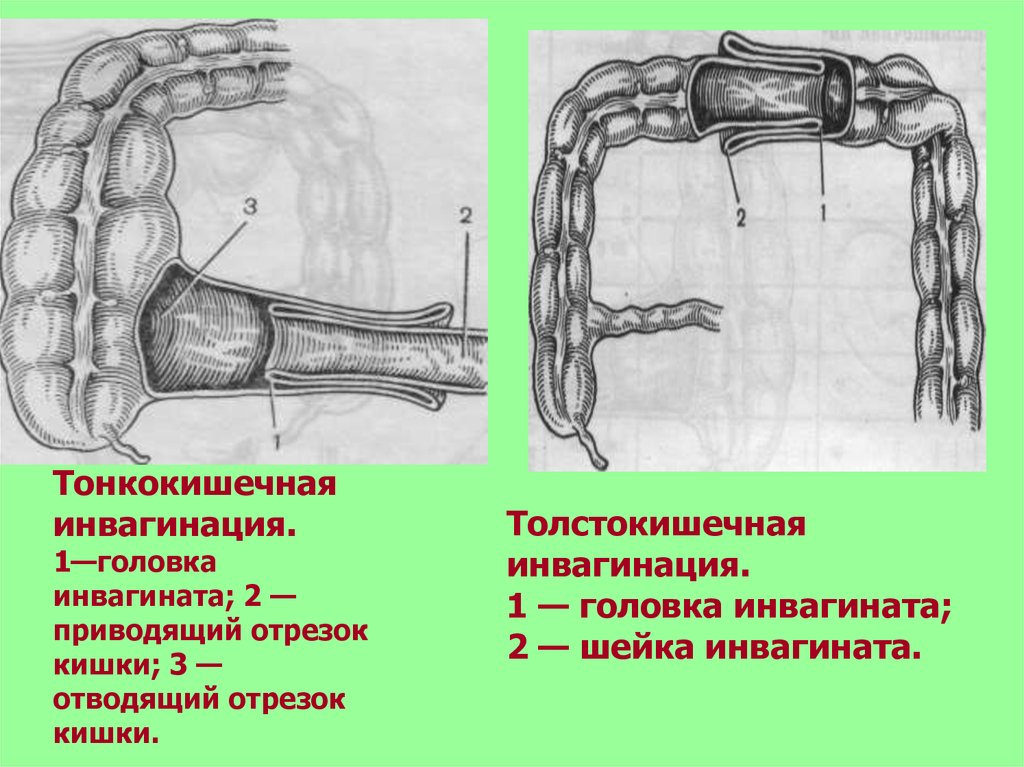 Инвагинация кишечника. Инвагинация тонкой кишки. Инвагинация кишечника схема. Тонко-толстокишечная инвагинация.