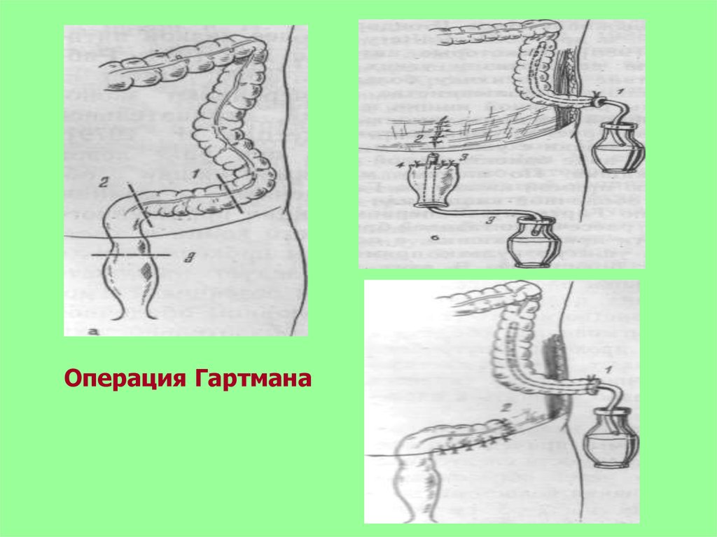 Схема операция гартмана