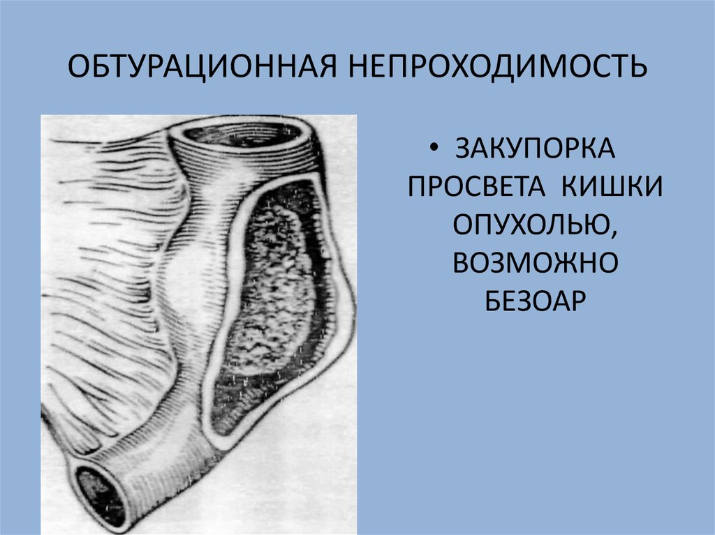 Обтурационная форма рака. Обтурационная кишечная непроходимость. Обтурационная кишечная непроходимость методичка. Обтурационной кишечной непроходимости. Механическая обтурационная кишечная непроходимость.