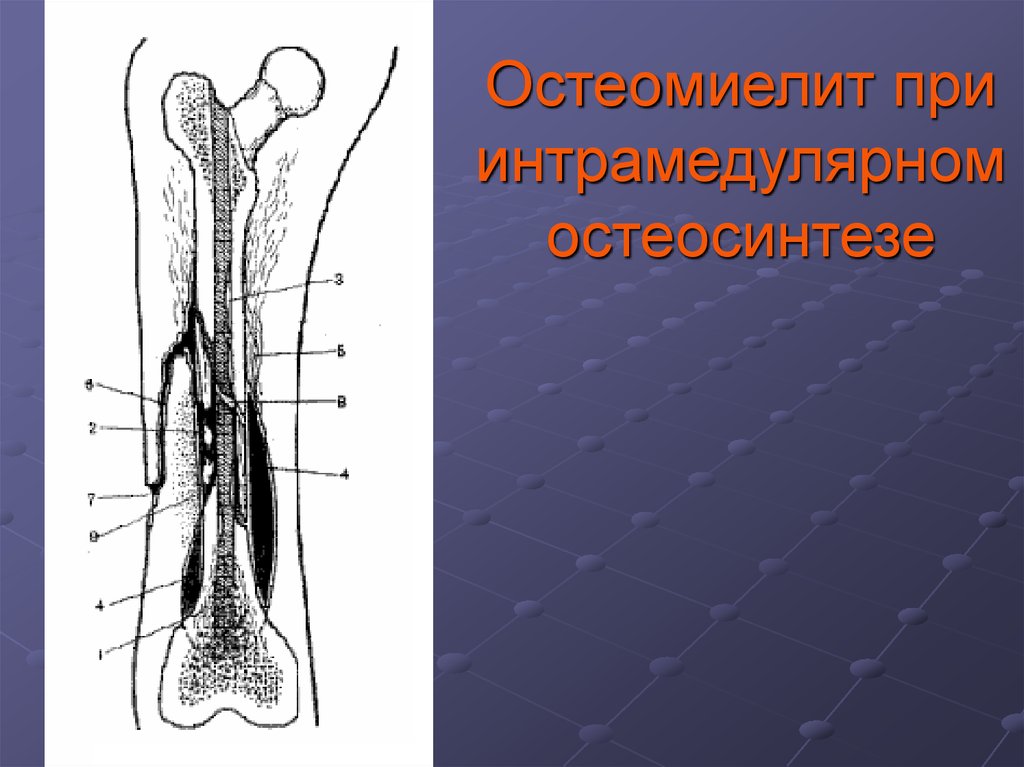 Острый остеомиелит диагностика