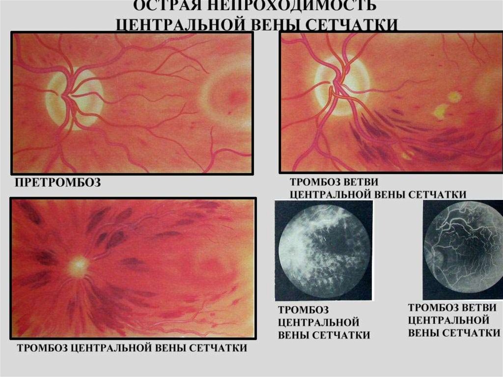Схема лечения тромбоза вен сетчатки