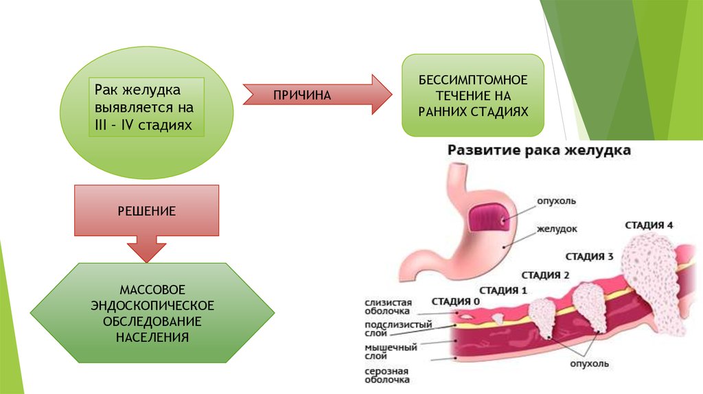 Клиники жкт. Этиология новообразований желудка. Опухоль желудка стадии. Патогенез онкологических заболеваний желудка. Локализация опухоли желудка.