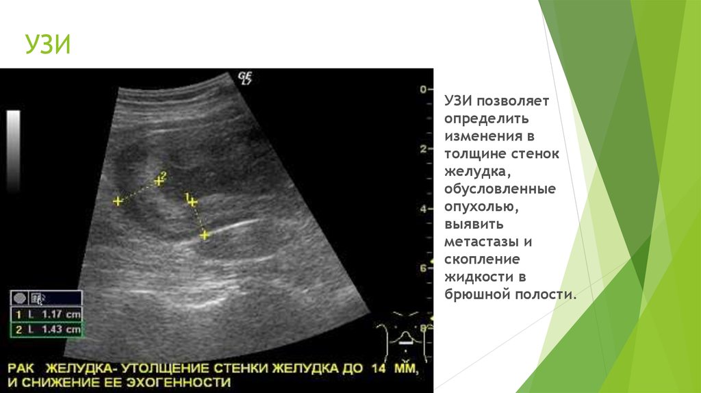 Можно по узи определить. Толщина стенки желудка на УЗИ. Толщина стенки желудка в норме при УЗИ. Толщина стенки желудка в норме на УЗИ. Утолщение стенок желудка на УЗИ.