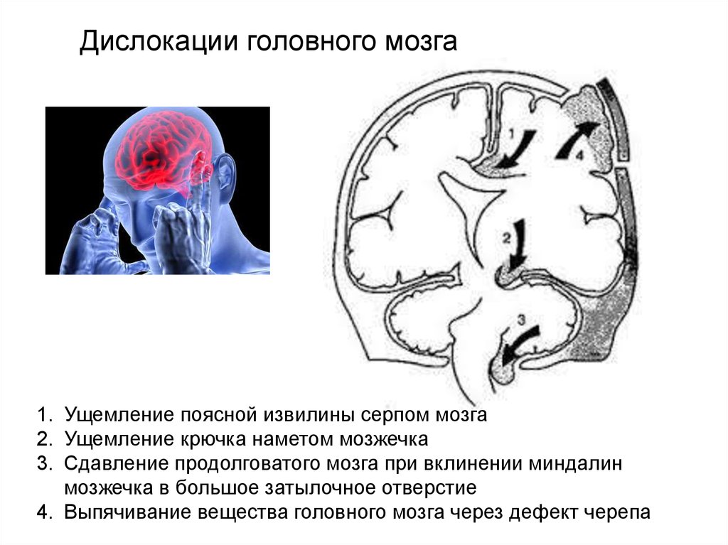 Проведенные на головном мозге. Вклинение ствола головного мозга кт. Симптомы смещения головного мозга. Дислокация срединных структур головного мозга. Аксиальная дислокация головного мозга.