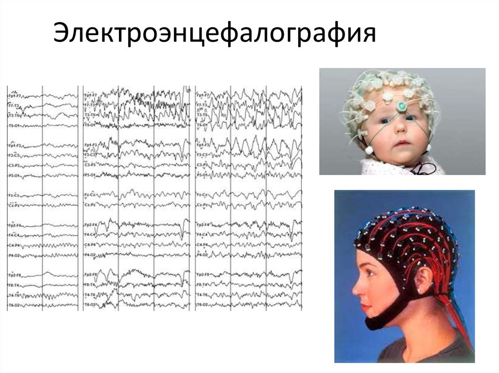 Клиническая электроэнцефалография с элементами эпилептологии руководство для врачей