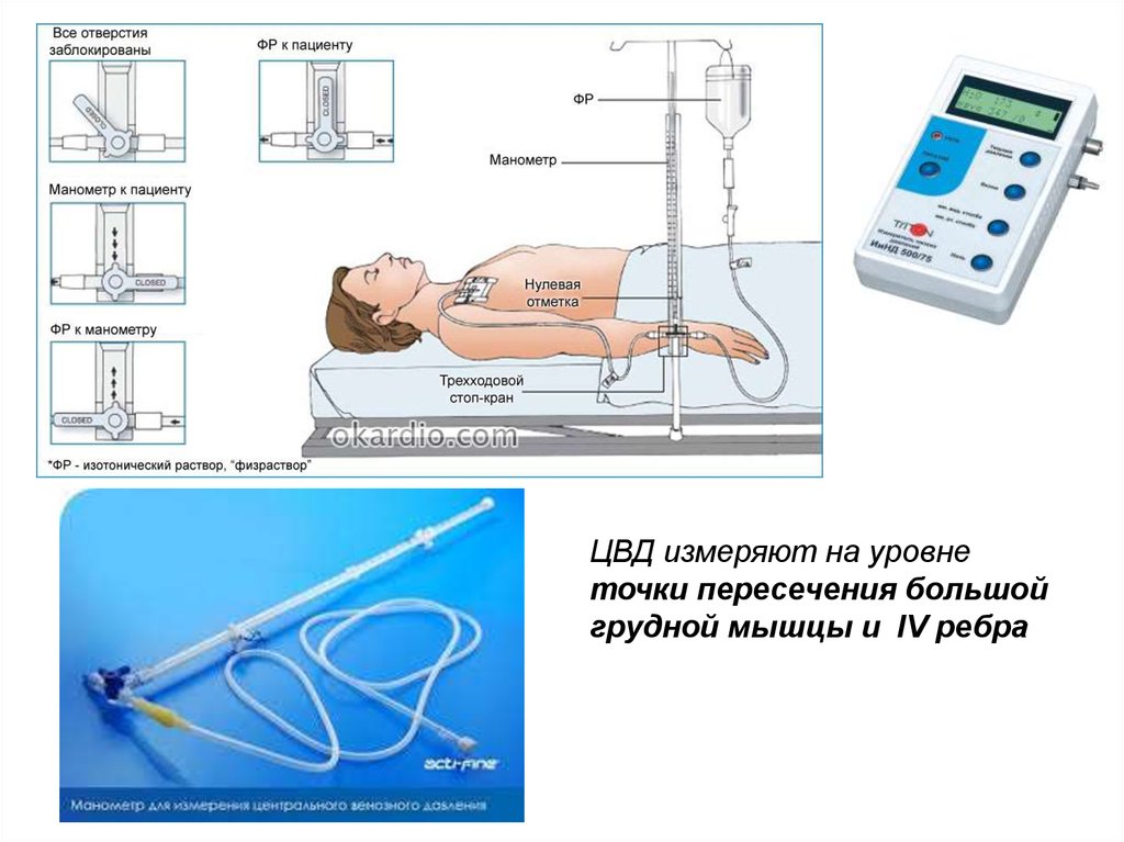 Метод измерения венозного давления. Измерение центрального венозного давления (ЦВД). ЦВД Вальдмана. ЦВД аппарат Вальдмана. Измерение ЦВД С помощью капельницы.