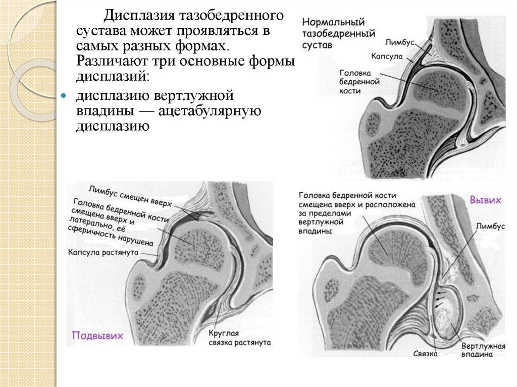 Дисплазия это. Лимбус тазобедренного сустава. Дисплазия вертлужной впадины тазобедренного сустава. Вертлужная впадина Лимбус. Лимбус тазобедренного сустава у новорожденных.