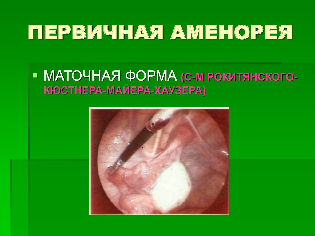 ПЕРВИЧНАЯ АМЕНОРЕЯ