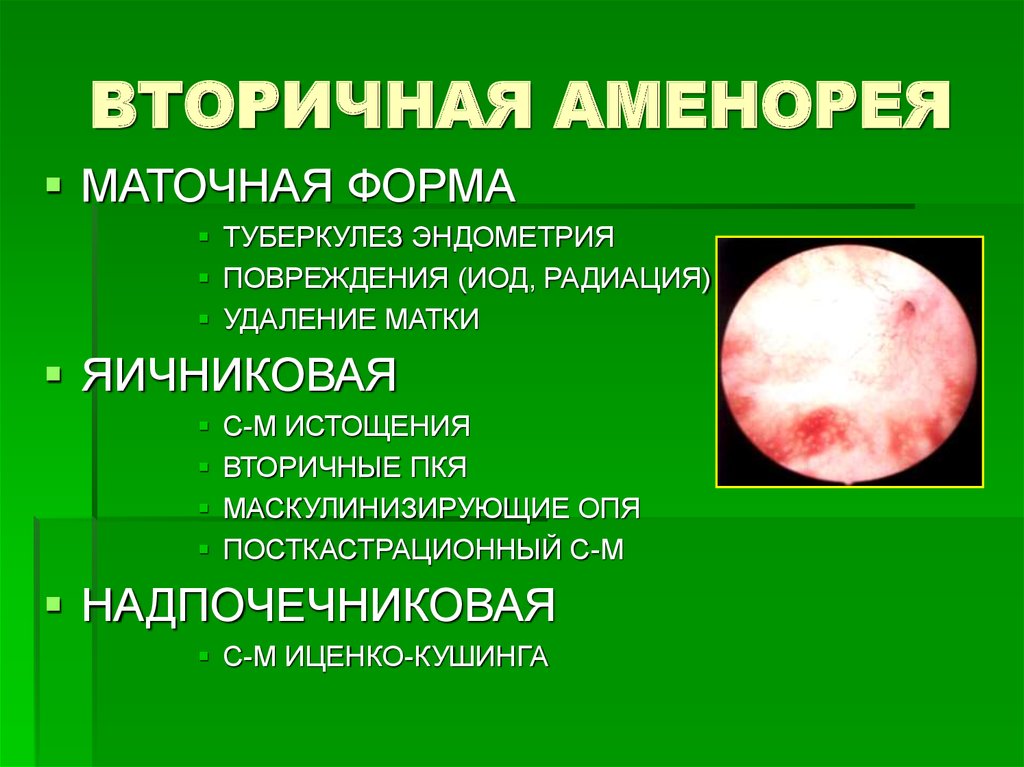 ВТОРИЧНАЯ АМЕНОРЕЯ