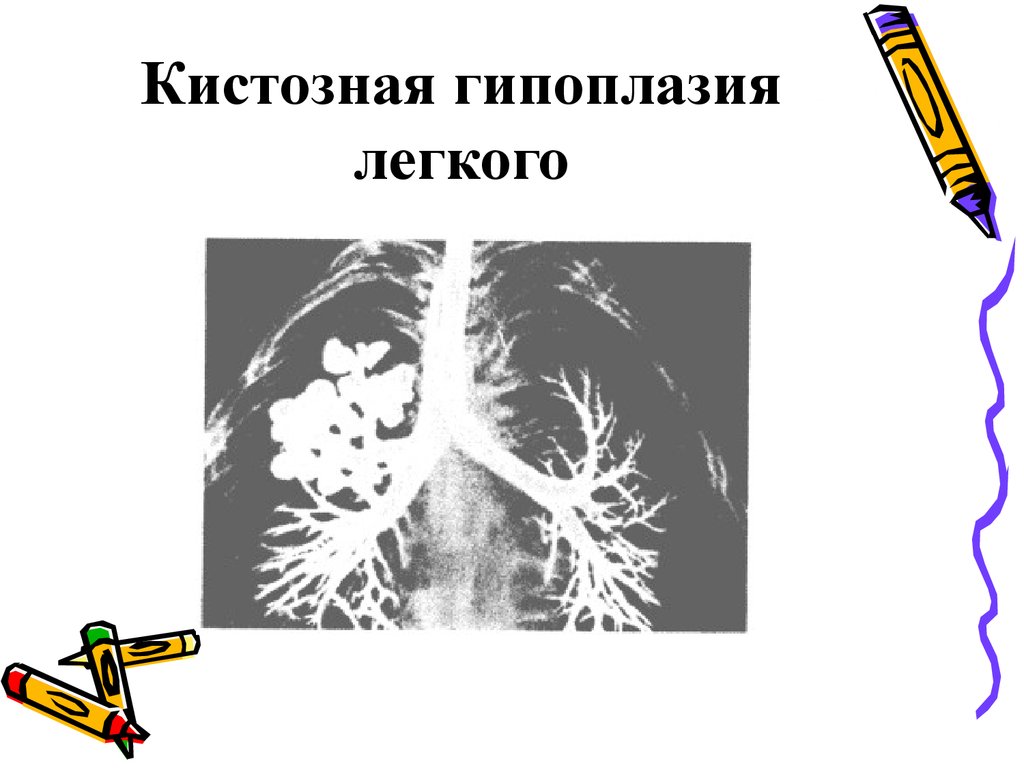 Гипоплазия легкого презентация