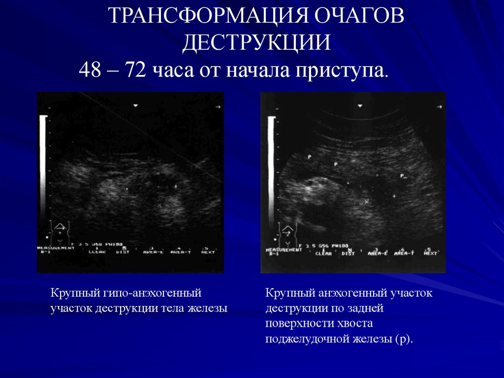 Анэхогенное образование. Анэхогенный участок. Гипо-анэхогенное образование. Анэхогенное образование Размеры. Очаговые изменения в молочной железе амэхоген.