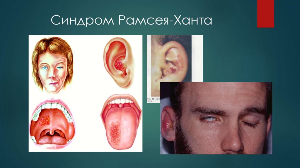Varicella Zoster Virus - online presentation