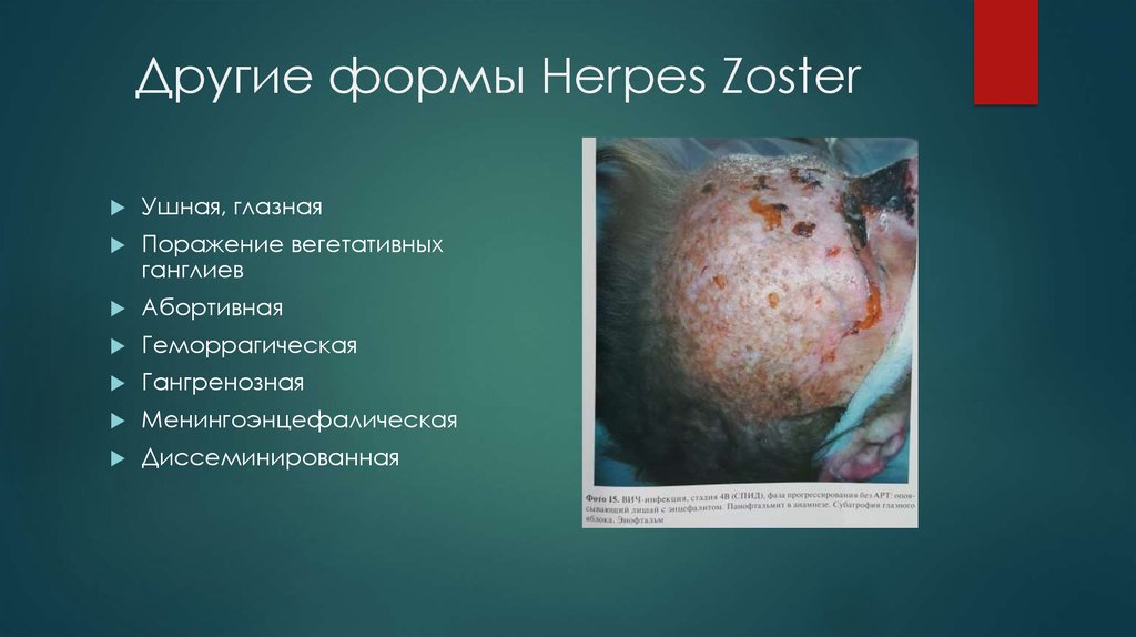 Другие формы Herpes Zoster