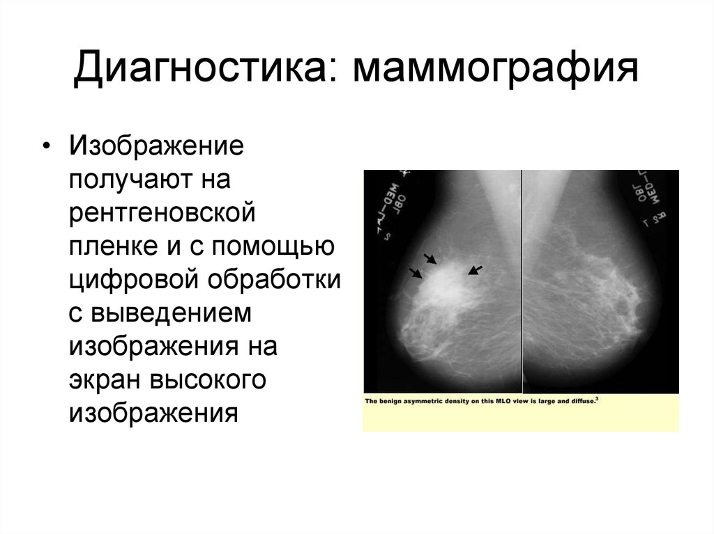 Маммография ударение. Диагноз маммографии. Диагноз при маммографии. Интерпретация маммографии. Интерпретация результатов маммограммы.