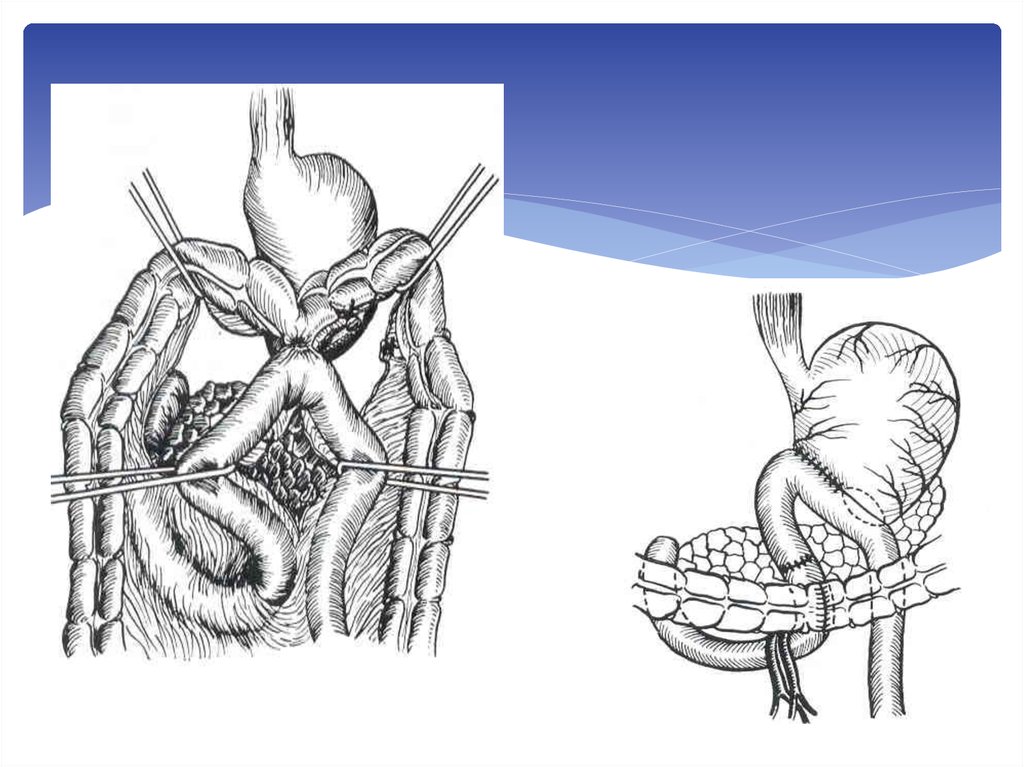 Болезни оперированного желудка презентация