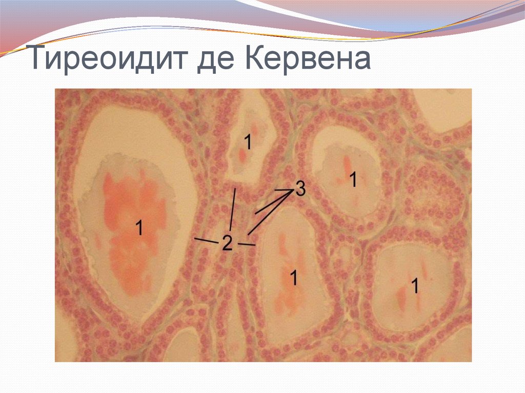 Лимфоцитарный тиреоидит