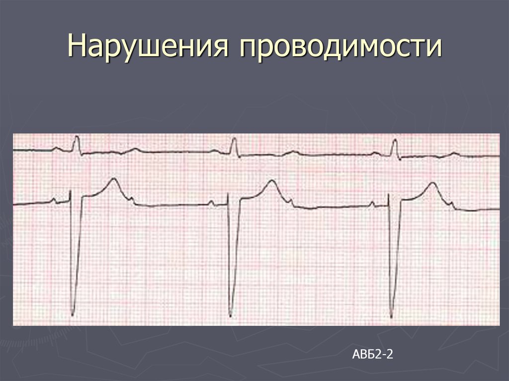 Нарушение проводимости. Синдромы нарушений проводимости ЭКГ. Нарушение проводимости на ЭКГ. Нарушение проводимости pdf. Нарушение проводимости армия.