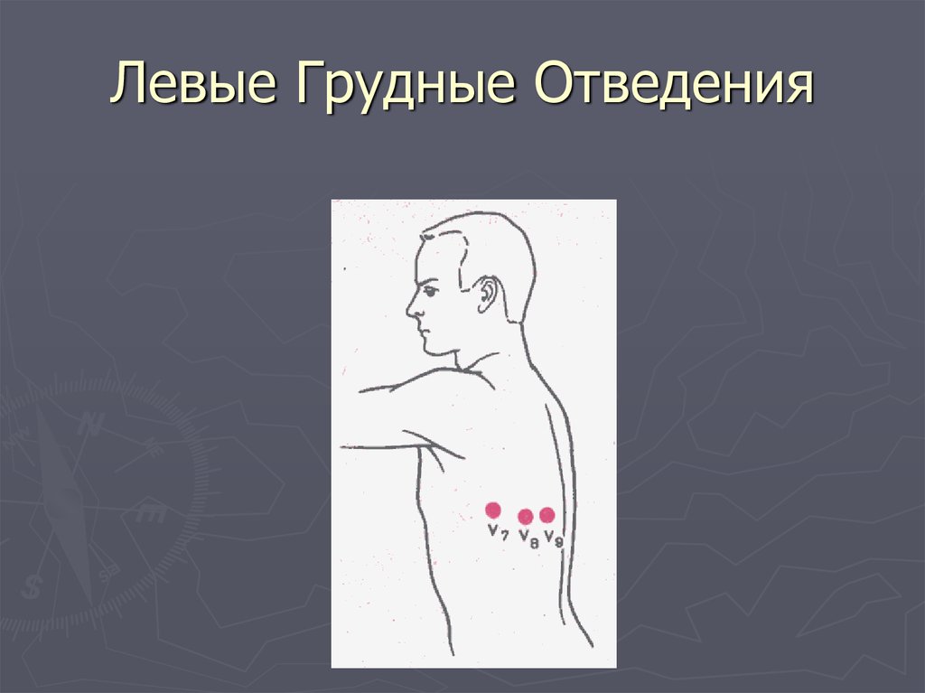 Левой грудной. Левые грудные отведения на ЭКГ. Правые грудные отведения на ЭКГ. Правые и левые отведения на ЭКГ. Правые крайние грудные отведения ЭКГ.