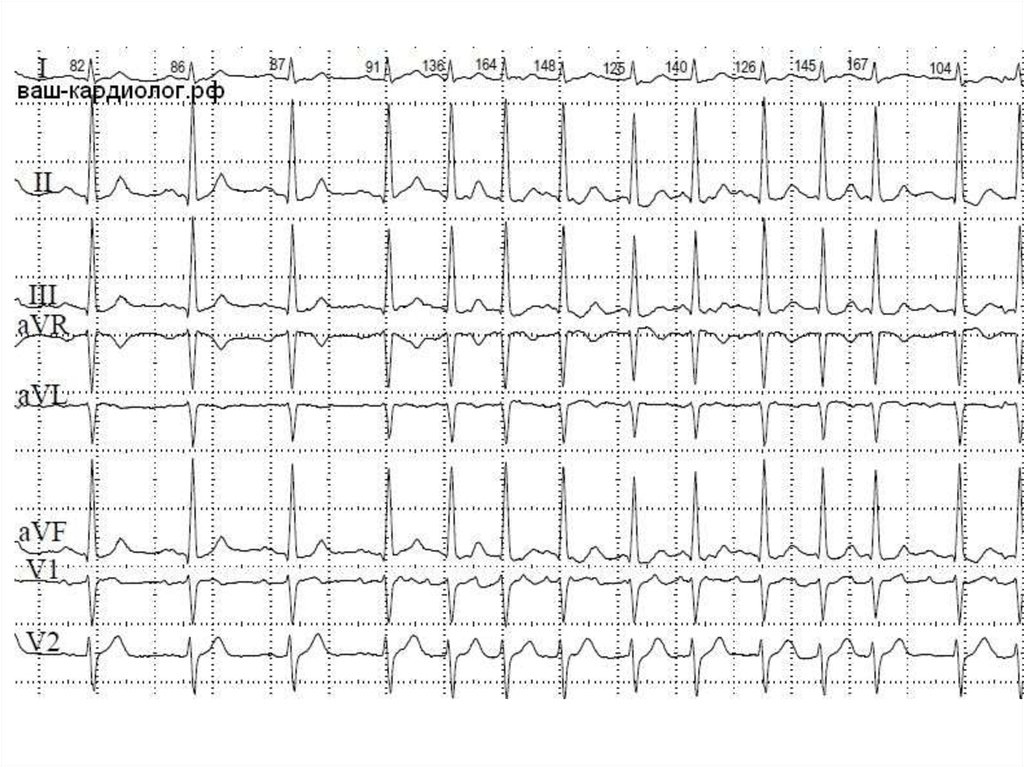 Экг предсердий. Фибрилляция предсердий тахисистолическая форма ЭКГ. Фибрилляция предсердий Мерцательная аритмия ЭКГ. Ритм фибрилляции предсердий ЭКГ. ЭКГ при фибрилляции предсердий.