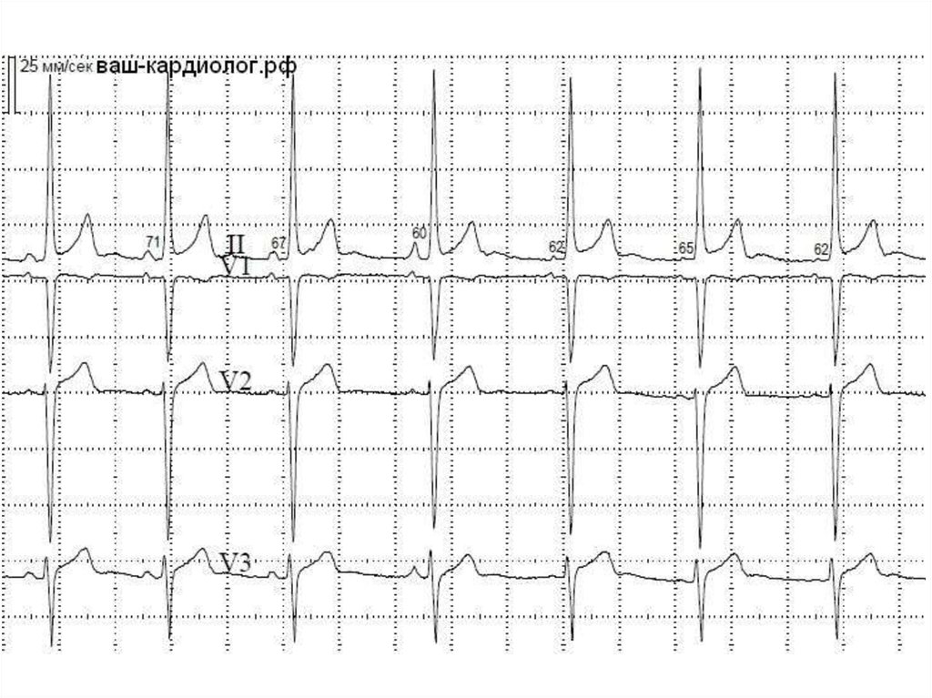 Ритм на экг. Миграция водителя ритма на ЭКГ. Миграция предсердного водителя ритма ЭКГ. Водитель ритма на ЭКГ. Миграция наджелудочкового водителя ритма на ЭКГ.