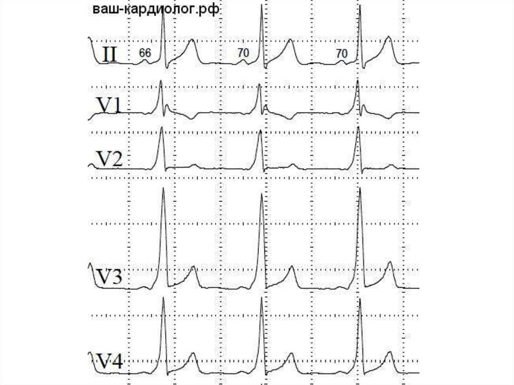 Экг примеры. ЭКГ на догоспитальном этапе. Ваш кардиолог РФ ЭКГ. Зубья пилы на ЭКГ. Снижение питания на ЭКГ.